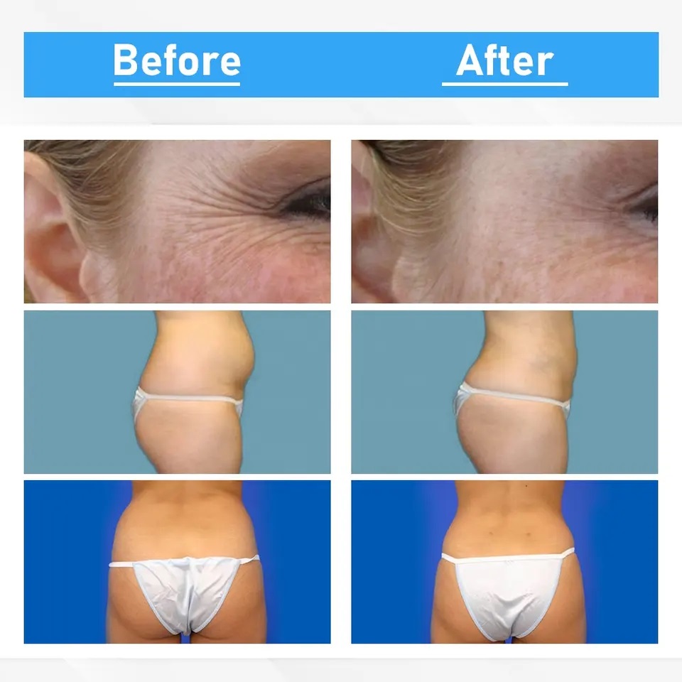 80K Cavitation Machine for Body Slimming & Skin Tightening, Ultrasonic Cavitation with RF, Lipo Laser & Vacuum for Fat Reduction & Cellulite Removal