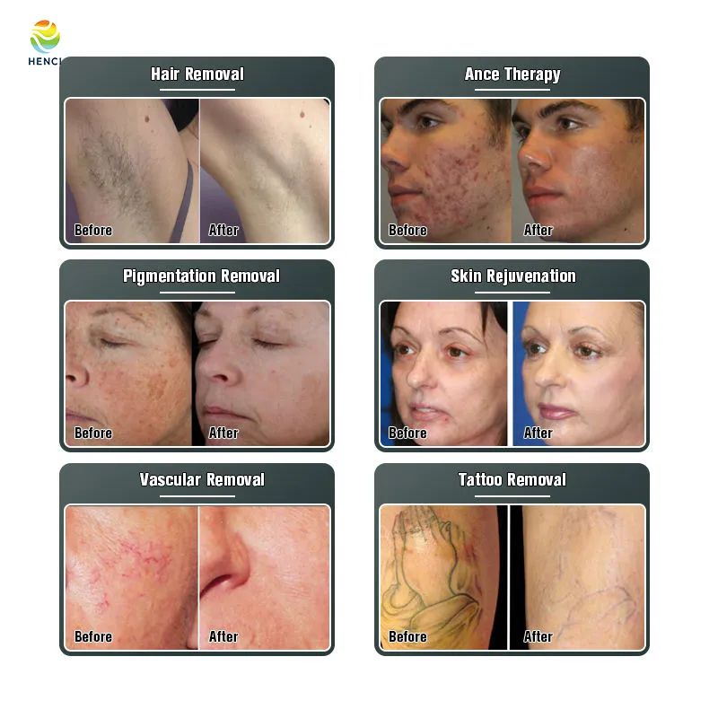 IPL Elight Nd yag laser machine Hair tattoo removal wrinkle reduce 300,000 Shots beauty equipment