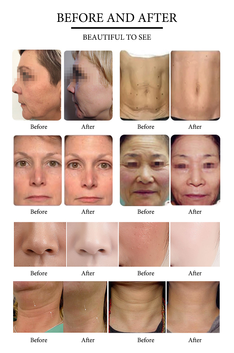 Portable Intracel Microneedle Rf facial machine skin tightening rf fractional needle wrinkle removal machine