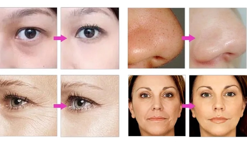 5in1 Water Hydro Dermabrasion Ultrasound Skin Care Acne Scars Removal Spa Use Face Cleaning Equipment