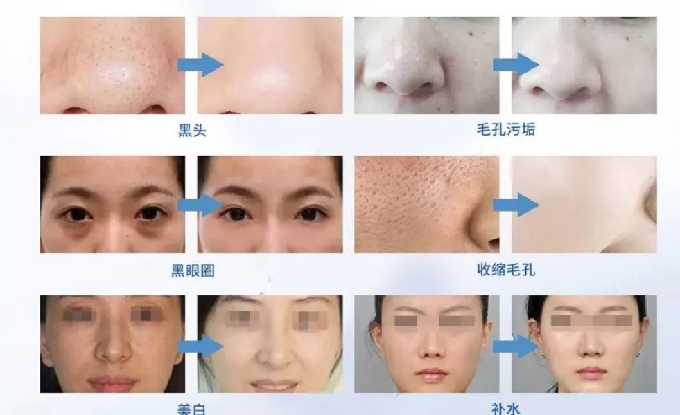 Multifunctional Face Skin Care Hydrogen Oxygen Small Bubble Beauty Machine Hydro Dermabrasion Machine