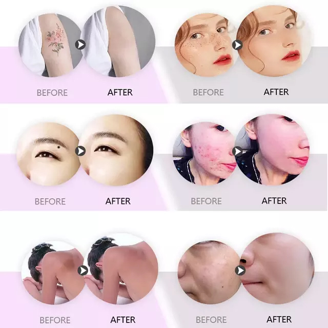 Vertical 808nm diode Laser permanent hair removal q switched nd yag 755nm