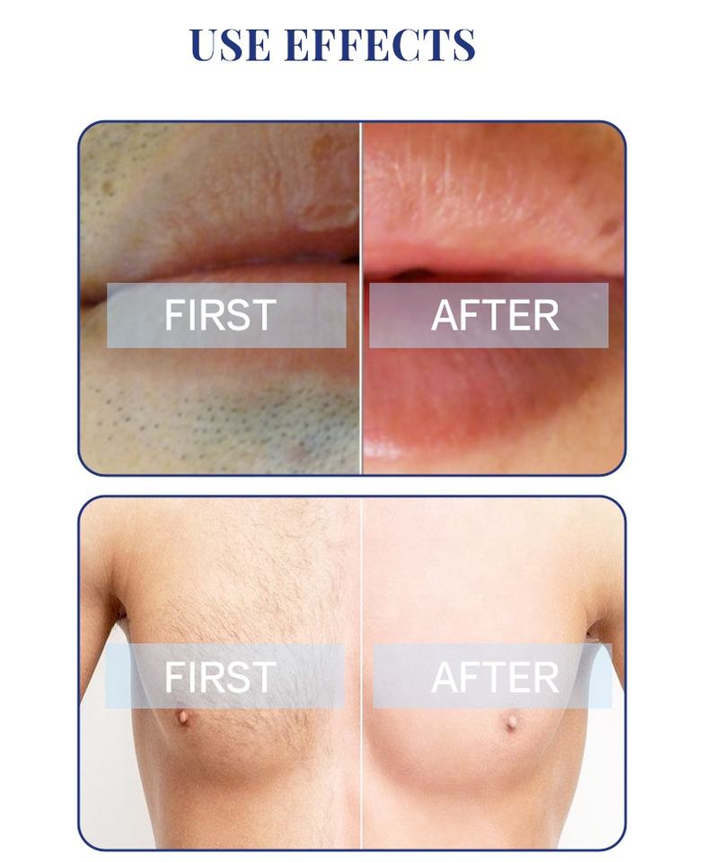 Ice cooling diode laser 755 808 1064nm/808nm diode laser hair removal machine price