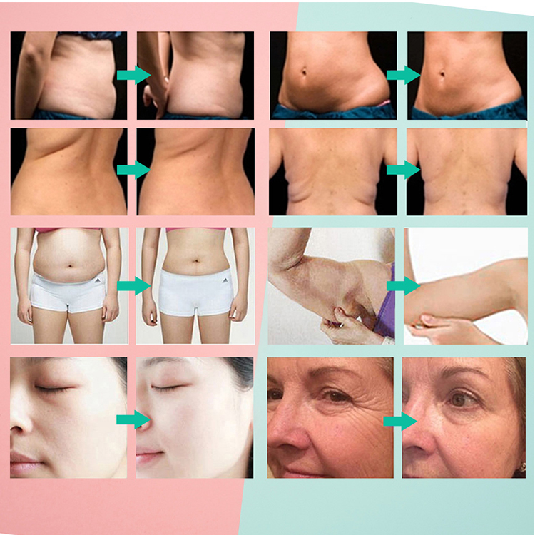 Portable 5-in-1 Fat Burning Body Massager Anti-Cellulite Body Sculpting Machine for Beauty Personal Care 40K RF Ultrasonic Cavitation Lipo Suction for