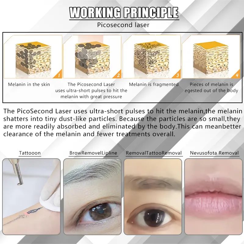 2023 Picosecond Laser Machine Picolaser Tattoo Removal Black Doll Carbon Laser Skin Whitening Acne Scar Age Spots Freckles Removal Beauty Skin Care De