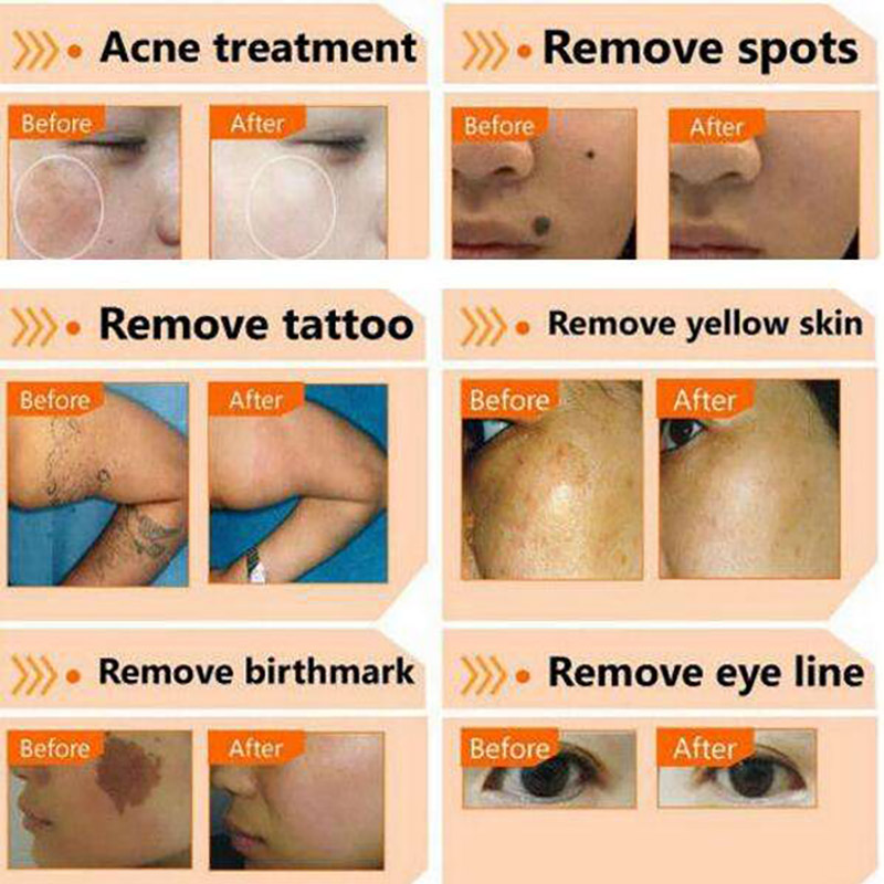 Diode Laser Nd Yag Pico 808 Skin Rejuvenation Tattoo Removal Laser Tattoo Removal Machin