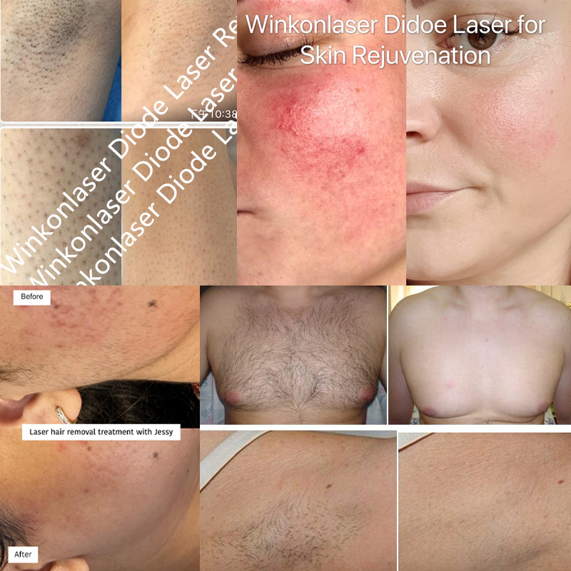 2023 808nm Laser Hair Removal Machine Diode Laser Ice Cool Epilator Lasers Hair Remover Body