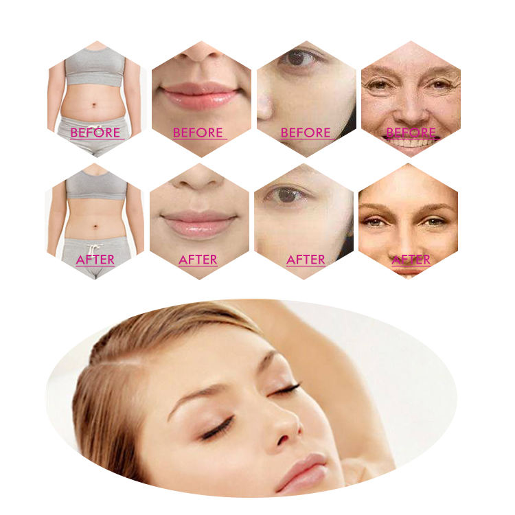 Non-Invasive 12 Lines Hifu Machine Face Body 4d Hifu Anti wrinkle 5d Hifu Body Portable Mini Smas Lift Hifu Face Machine
