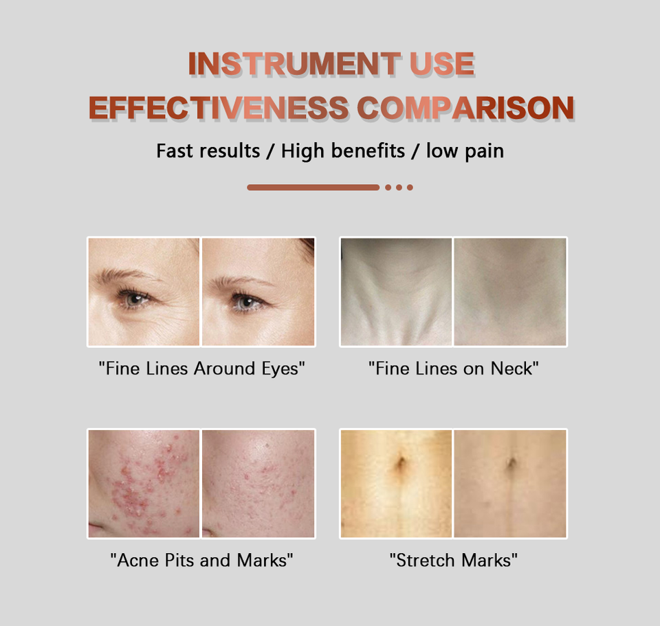 Latest Fractional Rf Wrinkle Remover Device Face Lifting Machine Rf Microneedling Machine Skin Tightening Elimina Las Estrias Beauty 2 IN 1 Machine