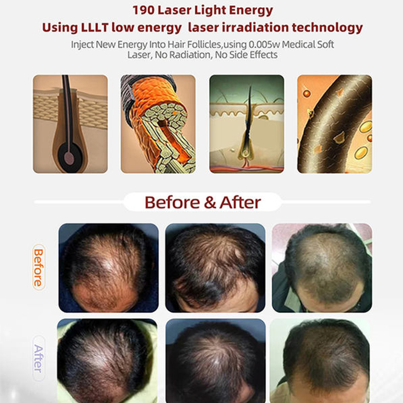 Hair LED Light Diode Hair Loss Treatment Grow Growth Laser Equipment 650nm Hair Regrowth Machine reduce hair loss machine led hair growth