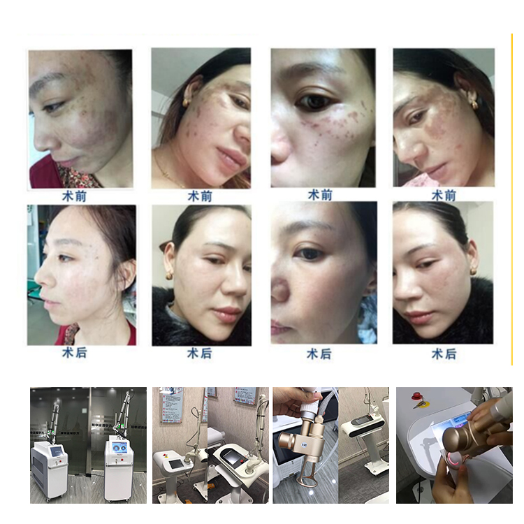 Multifunction co2 laser facial keloid scar removal co2 fractional skin remodeling laser machine
