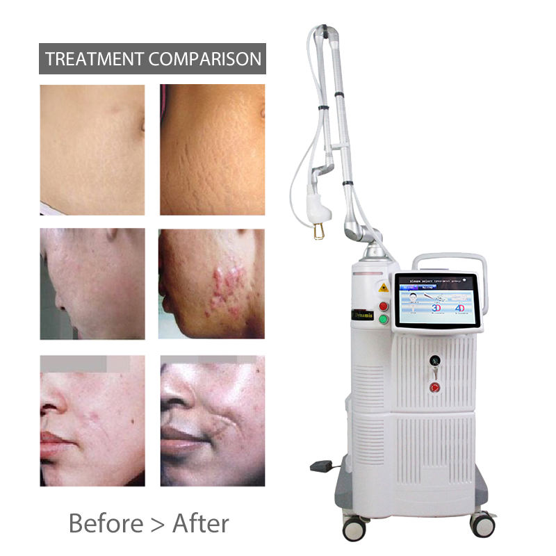 High frequency Fractional CO2 Laser 4D Fotona System lazer co2 fotona 4d rejuvenation laser co2 fractional laser