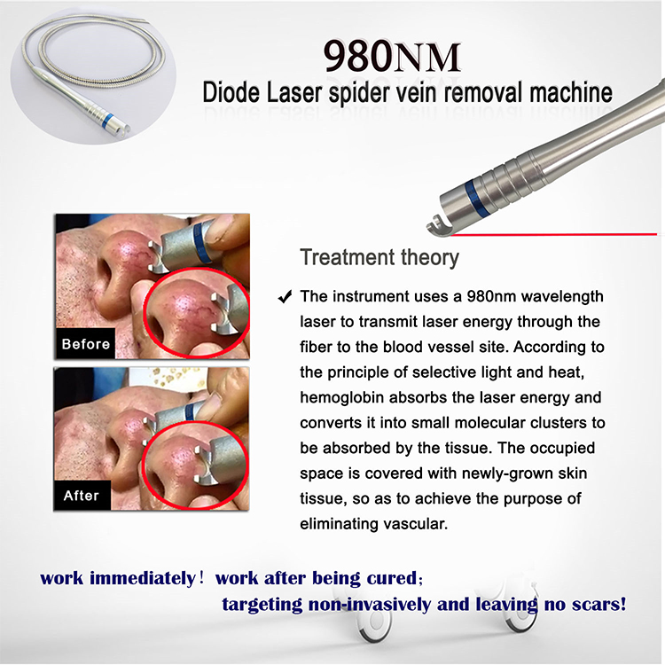 High Quality Diode Laser Vascular Treatment Machine Spider Vein Removal Laser Treatment High Effect Physiotherapy 980nm Diode Laser Equipment