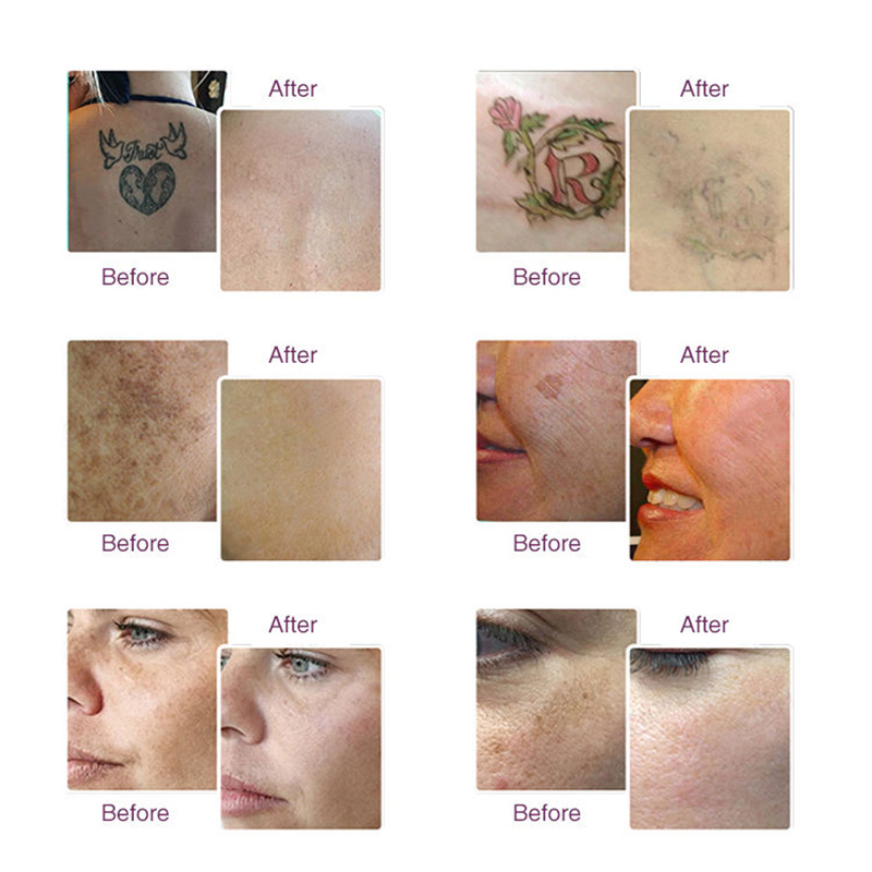 Hot Sale!!! Professional Picolaser Picosecond Laser Carbon Peel Q Switch Nd Yag Laser Tattoo Removal Machine