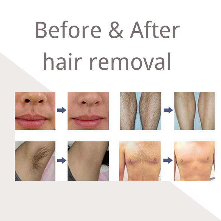 Hot Sale Vertical 808 Diode Laser Hair Removal Machine Q-Switched Nd Yag Laser Tattoo Removal Machine Ice Titanium 755 808 1064 Laser Epilator Tattoo 