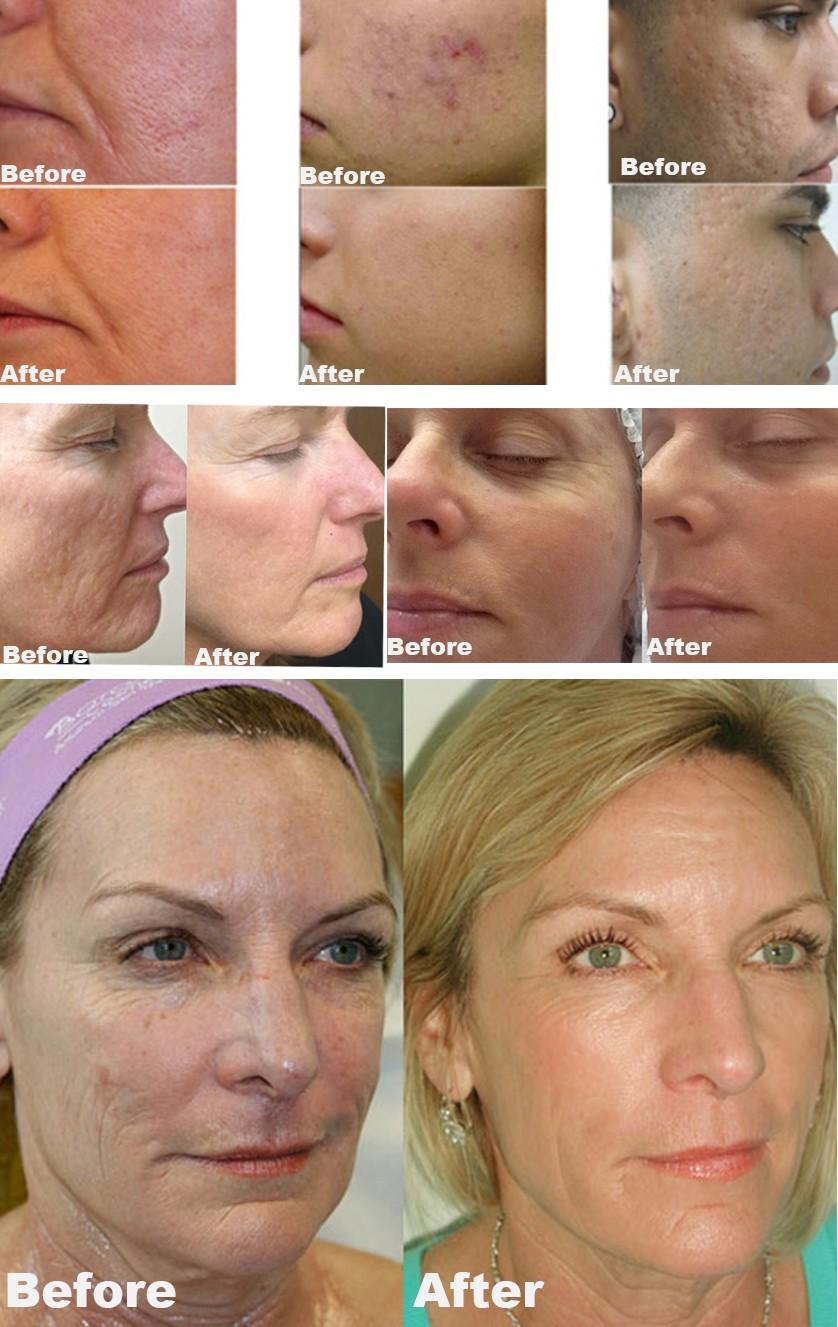 Intelligent Fractional RF Machine, Thermajie Radio Frequency Face Lift, Skin Tightening & Wrinkle Removal, Dot Matrix Technology