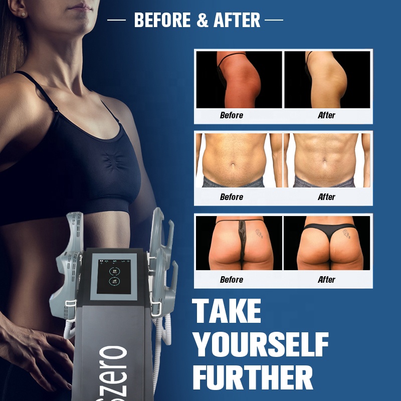 2022 4Handle EMT EMslim Electromagnetic Muscle Building Slimming Fat loss EMS