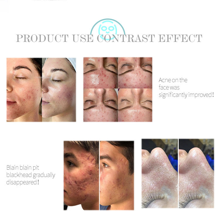 2022 dermabrasion deep cleansing machine water microdermabrasion Oxygen Spra Gun RF lift skin Scrubber black heads removal device