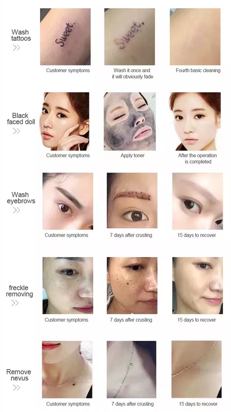Non-invasive Picosecond Laser Eyebrow Wash 532nm 1064nm 755nm Tattoo/Pigmentation Removal Yag Laser Machine