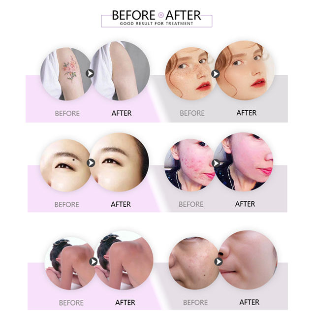 CE approved pigments tattoo removal varicose veins laser treatment q switched nd yag laser