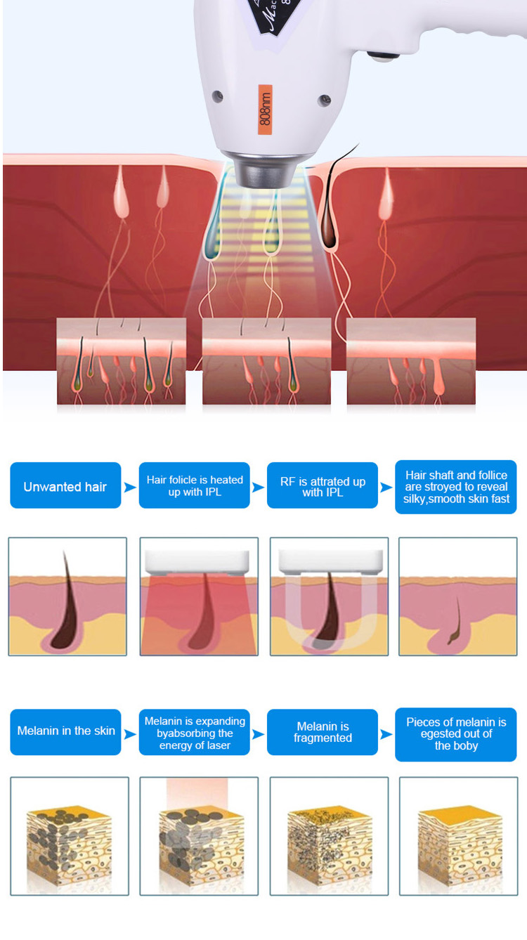 808 hair removal laser tattoo removal laser picosecond safe painless diode laser hair removal machine