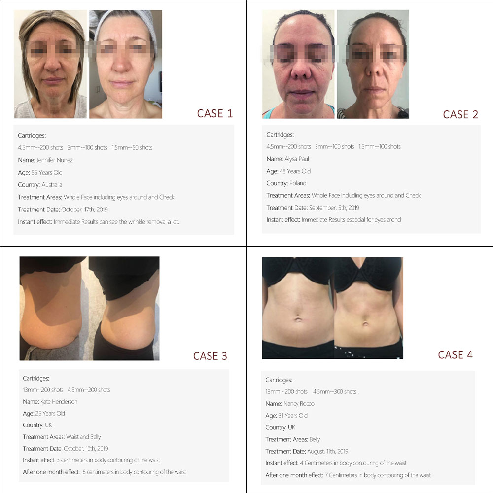 3D 4D 5D HIFU Machine Other Beauty Equipment Body Face Lifting and vmax HIFU 3 in 1 portable vaginal tightening rejuvenation