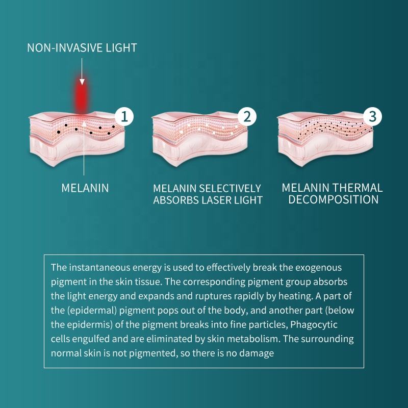 ND YAG Laser Tattoo Removal Wash Eyebrow Pigmentation Carbon Peeling Skin Rejuvenation Whitening