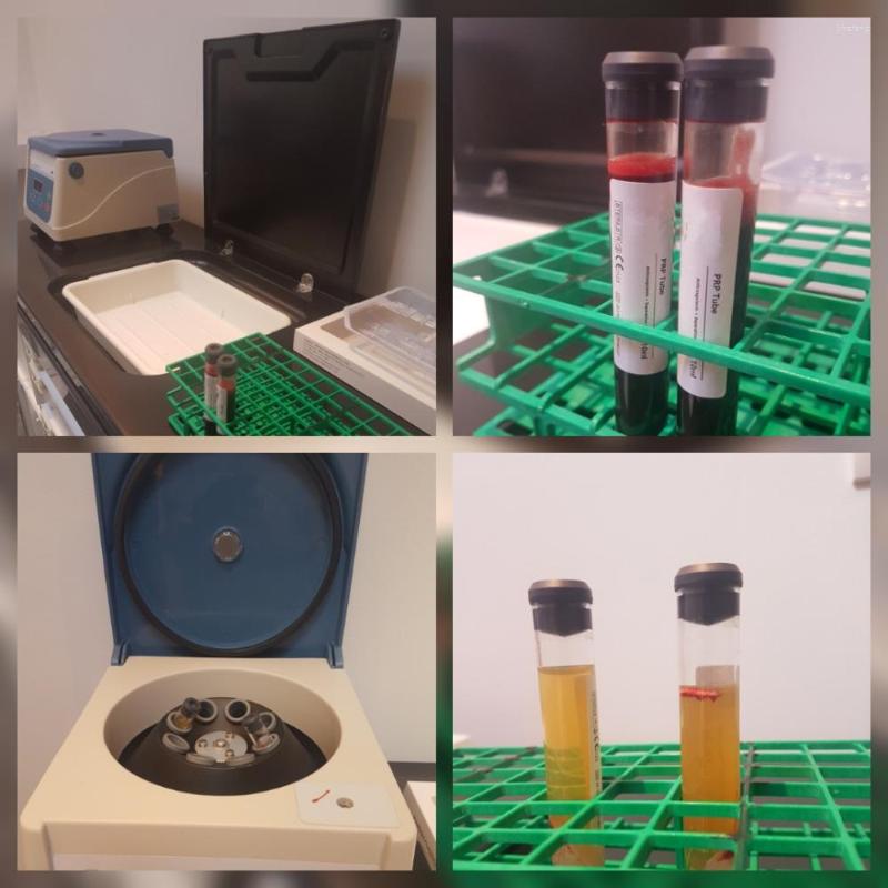 Centrifuge For 10pcs PRP Kit 8ml 10ml 12ml 15ml ACD GEL Tube Hair Facial Skin Care Beauty Dental Treatment
Centrifuge For 10pcs PRP Kit 8ml 10ml 12ml 15ml ACD GEL Tube Hair Facial Skin Care Beauty Dental Treatment