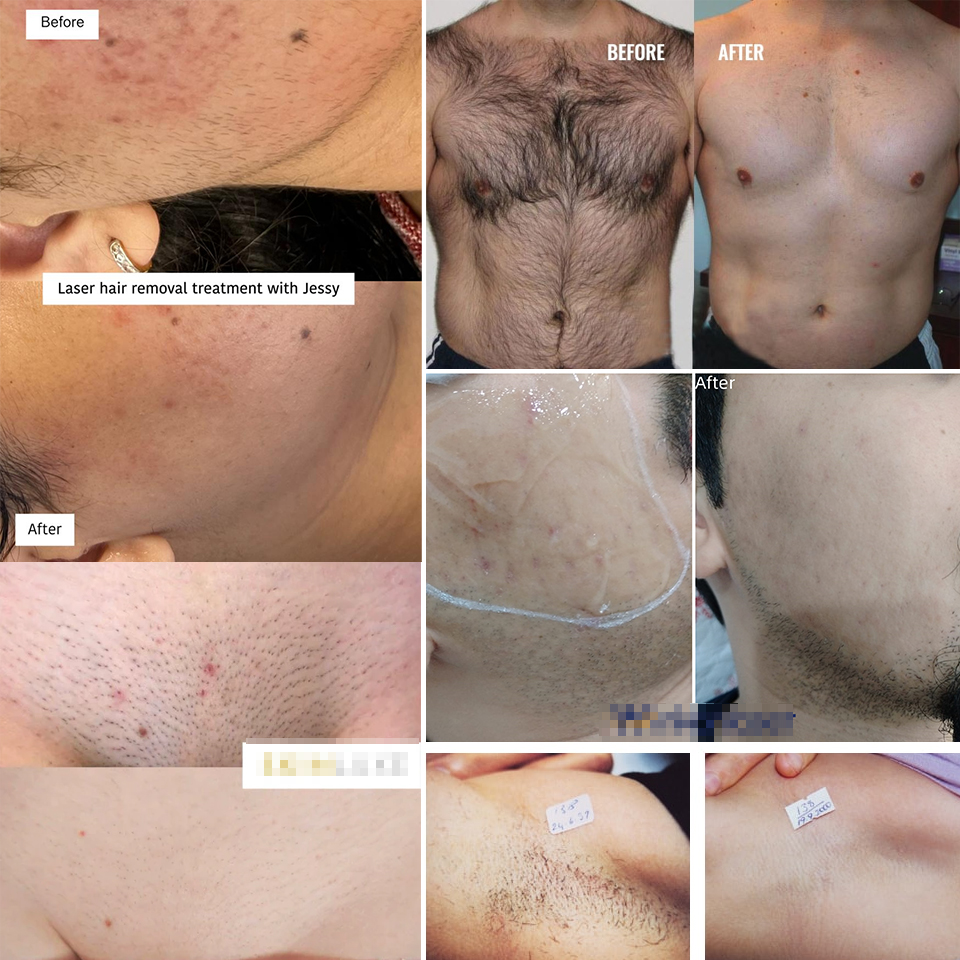 4 wavelengths Diode Laser Hair Removal Machine 755nm 940nm 808nm 1064nm Eliminate Hairs 808 Diode Lasers FDA CE approved