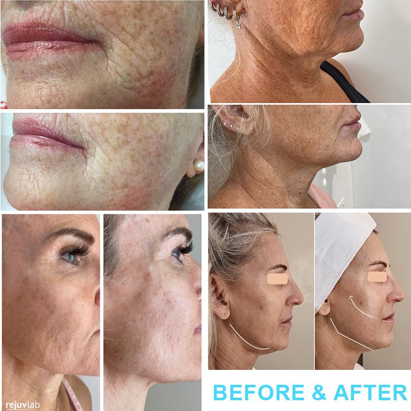 7D Hifu Machine Facial Other Beauty Equipment 11 Lines Hifu 25000 Shots Cartridge For Skin Lift Tighten