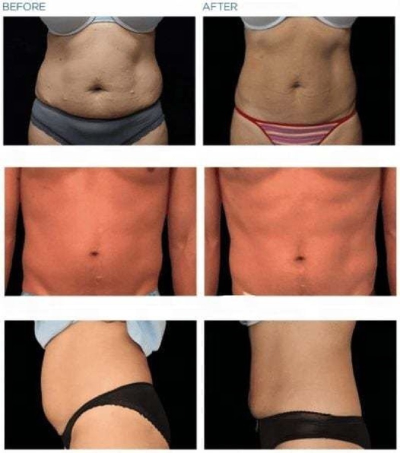 Electromagnetic Slimming Ems Muscle Build Fat Reduce 5 Rf Handles Machine Body Sculpting