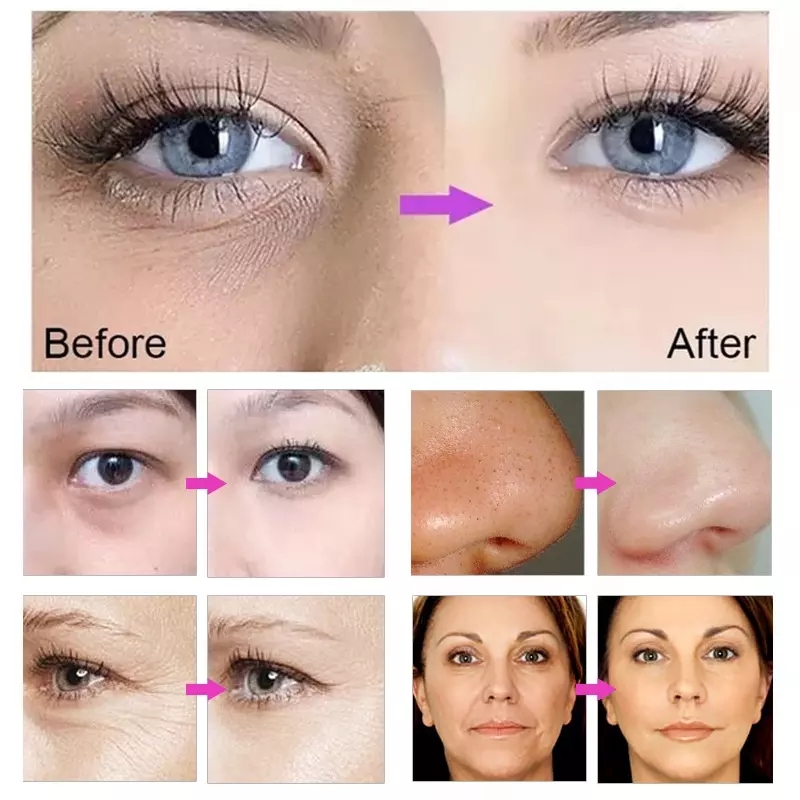 Professional newest face tightening cryo pen cryo skin cooling device