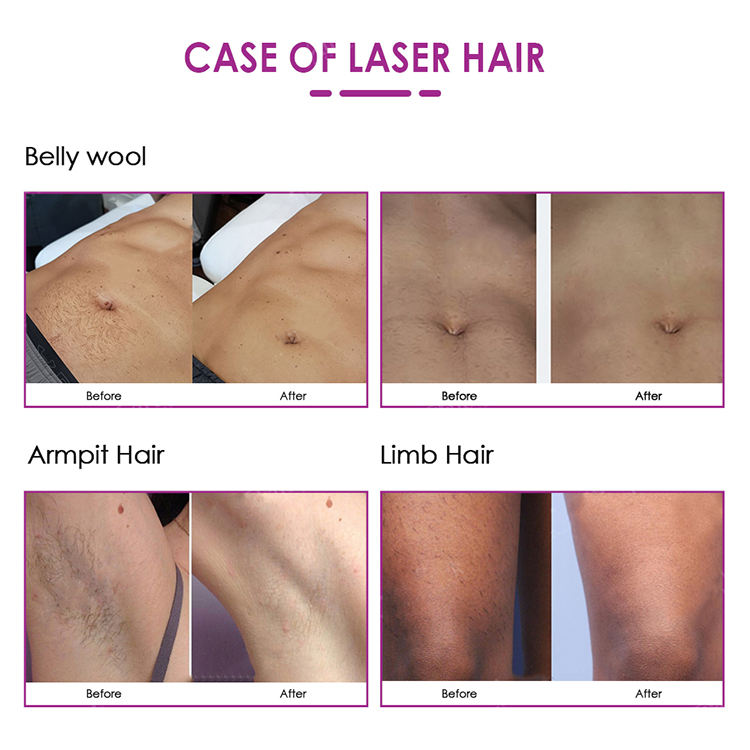 808nm Diode 3 Wavelength Laser Permanent Hair Removal Depilation Skin Rejuvenation Cooling Technology Machine