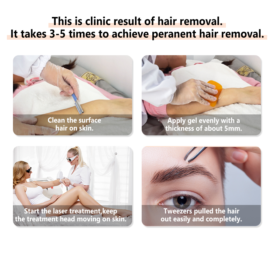 Non Crystal Diode Laser 3 Wavelength 755 808 1064 Laser Hair Removal Machine Price