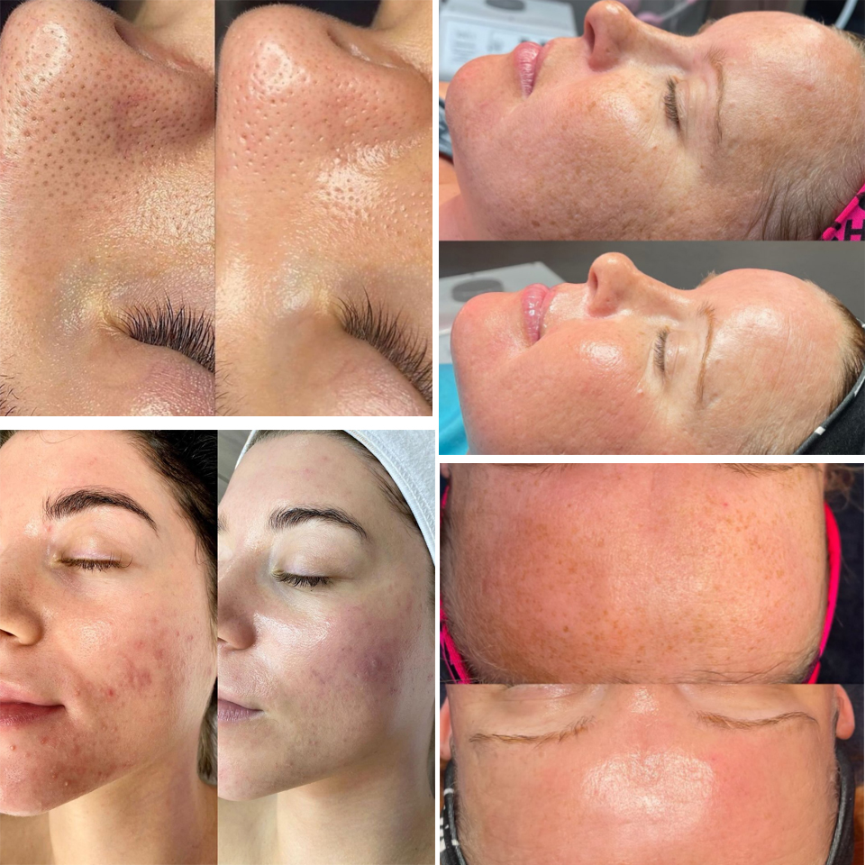 FDA approved facial Machine RF skin rejuvenation Microdermabrasion Hydro Dermabrasion Bio-lifting wrinkle removal hydra big discount