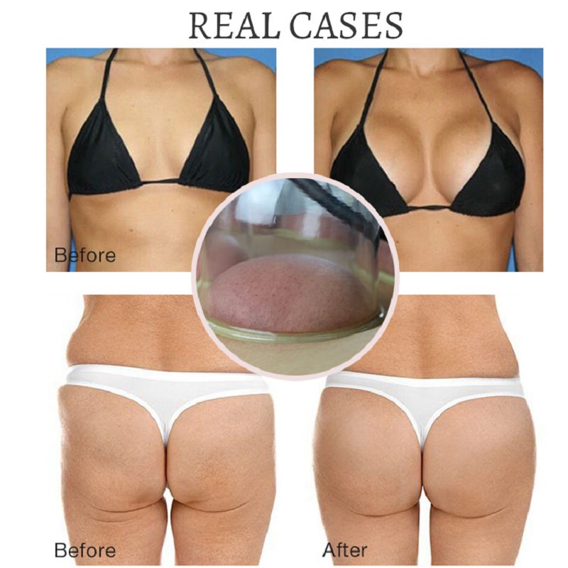 Portable Slim Equipment Wholesale Big Cups Buttocks Vacuum Therapy Machine Breast Enlargement Butt Lift Device Buttock Cupping Machine