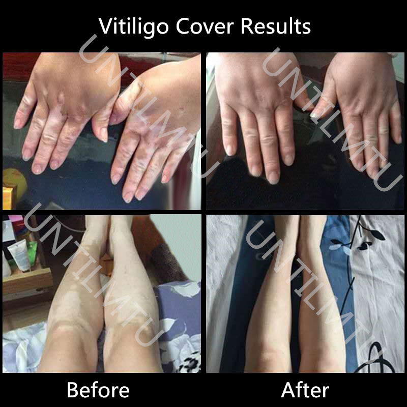 Permanent Makeup Inks Vitiligo Covering Waterproof Skin Condition Concealer Pen Long Lasting Women Men White Patch Face Body Spots 221109