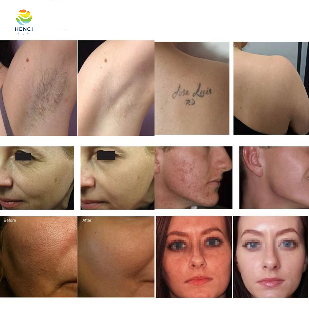 5 in 1 Multifunction Laser Machine High Power 3000W Elight OPT IPL Hair Removal Pigment Treatment Beauty Equipment