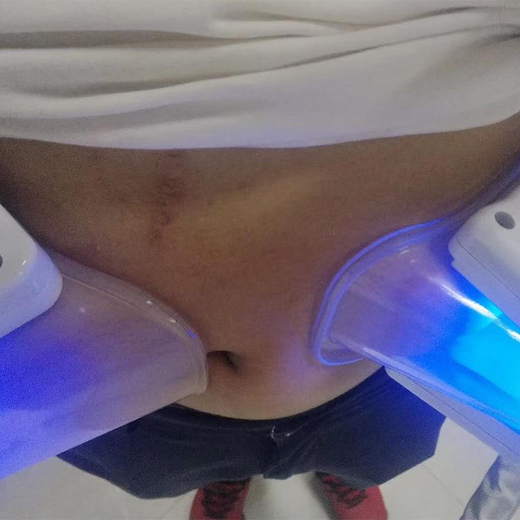Salon Criolipolisis Maquina fat freezing slimming machine for cellulite reduction Body Sculpting with Double Chin Cryo Handle