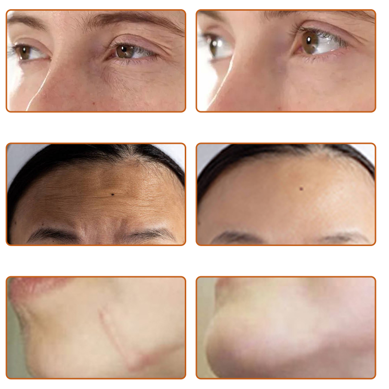 microneedle rf anti aging micro needle machine dark scar treatment SPA use device