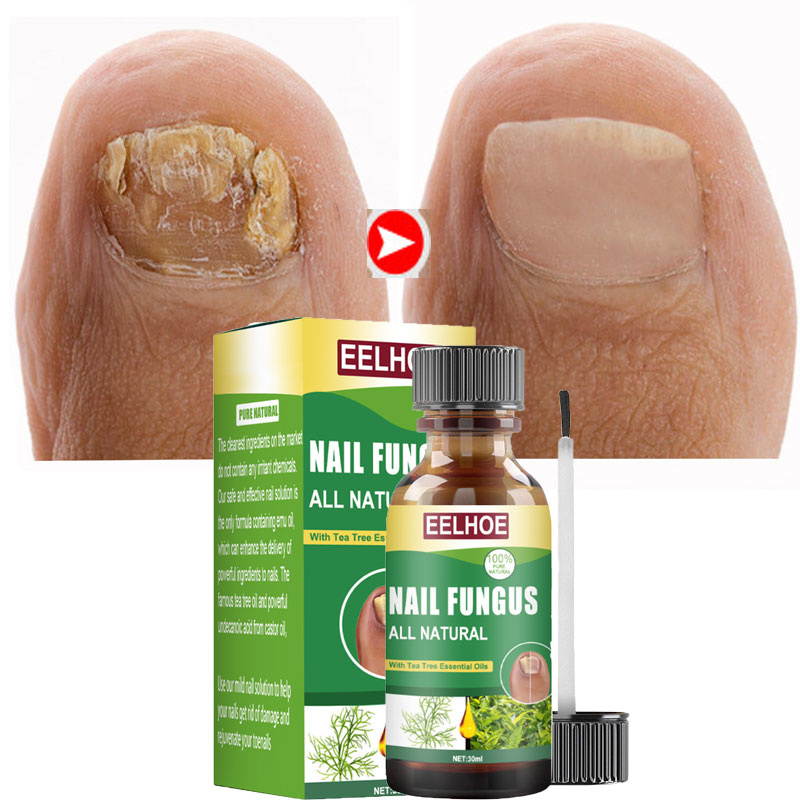 30ml Nail Fungal Treatment Feet Serum Anti Infection Foot Toe Fungus Removal Essence Gel Onychomycosis Paronychia Repair Care Pe