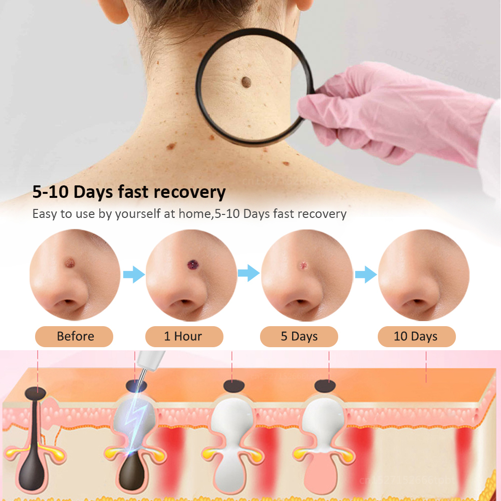 Face Care Devices Skin Tag Mole Remover for Dark Spots Laser Plasma Pen Electric Blemish Wart lcd Freckle Eliminator Black Dots Removal 221122