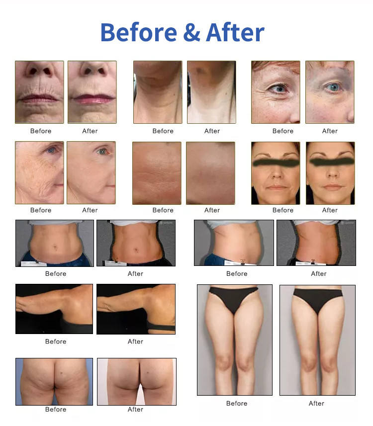 Good Salon dual handle hifu 7d facial y corporal 2022 SMAS face lifting and body slimming 7D hifu facial machine for salon