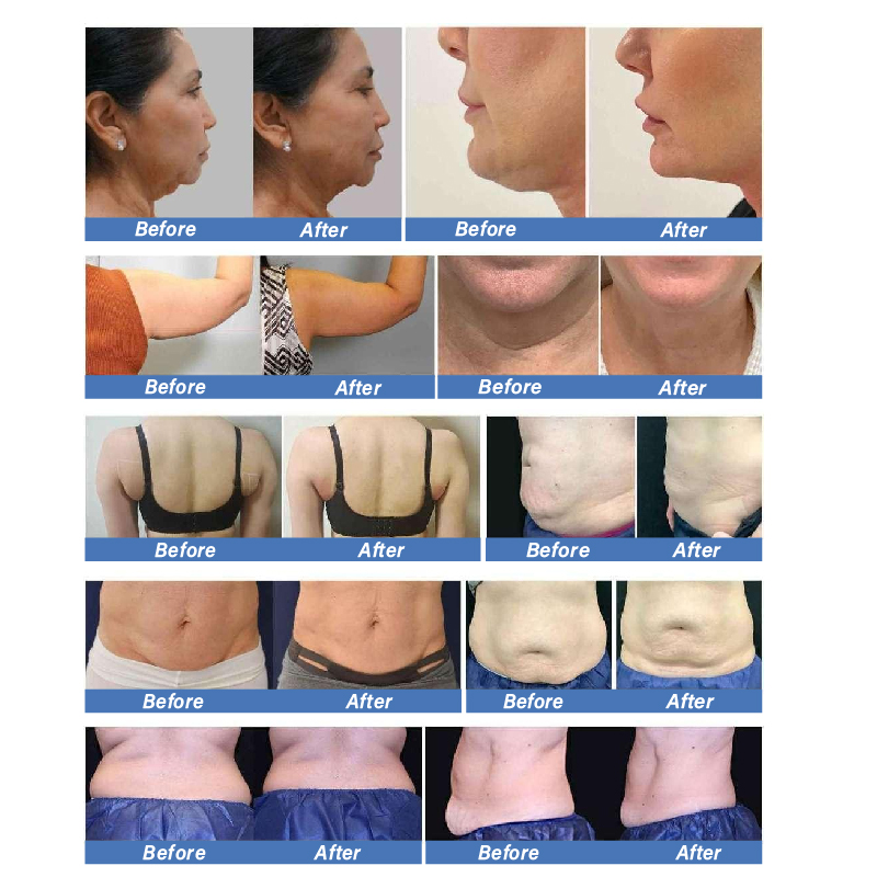 2023 Vertical Trusculpt Slimming Machine 1mhz Monopolar Fat Dissolving RF Radio Frequency Trushape Id Body SlimmingMachine With 8 Handles Loss Weight