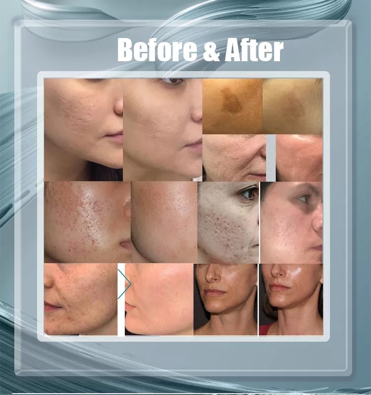 Multi 3 in 1 systems Fractional Co2 Laser For Scar Removal Skin Rejuvenation Rf carbon Laser Machine and women vaginal tighten beauty salon device pri