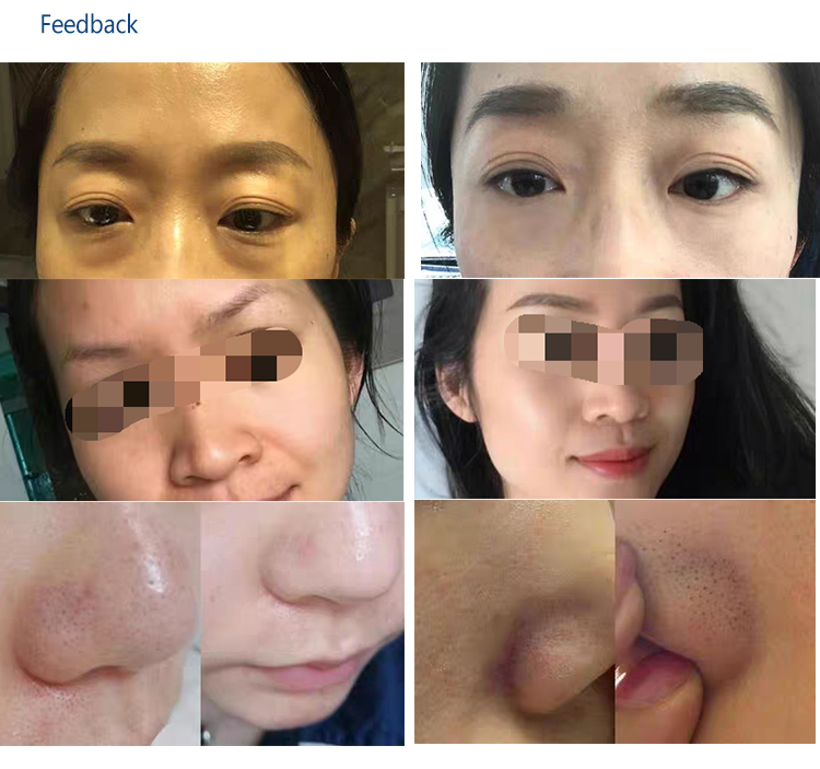 Beauty Equipment Microdermabrasion 11 in 1 Hydroface Aqua Jet Peel Hydrote Oxygen Facial Machine Price HD9