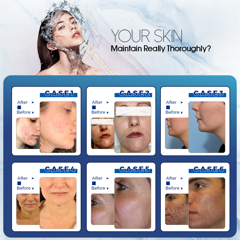 vacuum hydro oxygen microdermabrasion BIO Lifting RF facial machine dermabrasion peeling machines