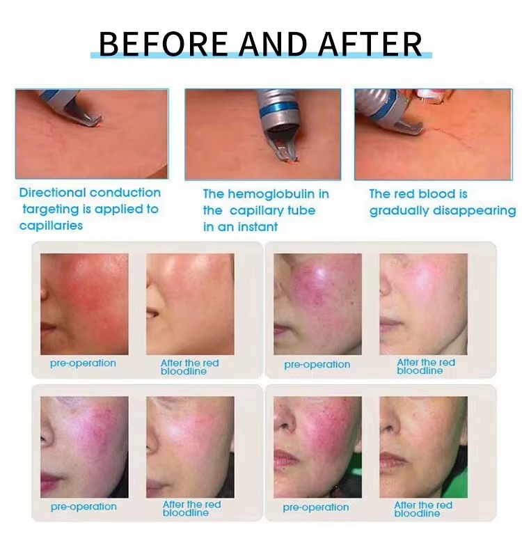 2026S Latest 30W 980Nm Diode Laser Vascular Removal And Spider Veins Removal/Blood Vessels Machine 980 Nm Diode Lasers Beauty Equipment