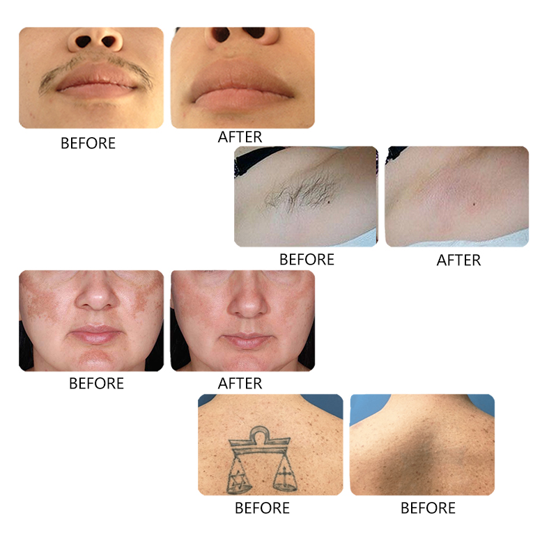 808Nm Laser Diode Hair Removal Machine Diode Skin Rejuvenation Ce Fda Approved Used SPA Equipment