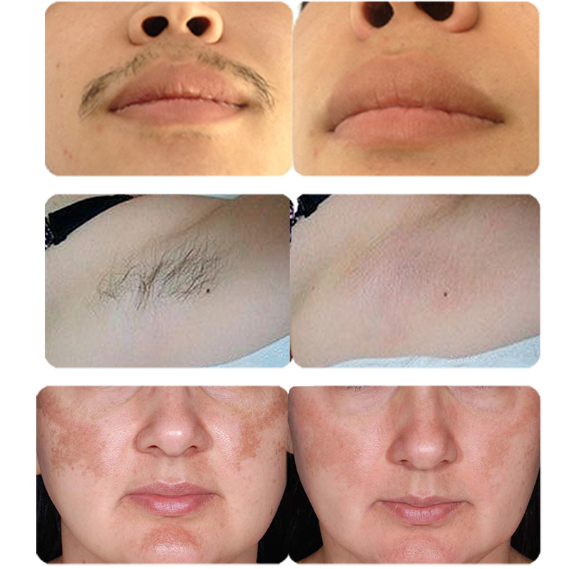Depilation machine 808nm 755nm 1064nm diode laser hair removal equipment dark white skin use Germany DLAS bar intelligent operation system painless an